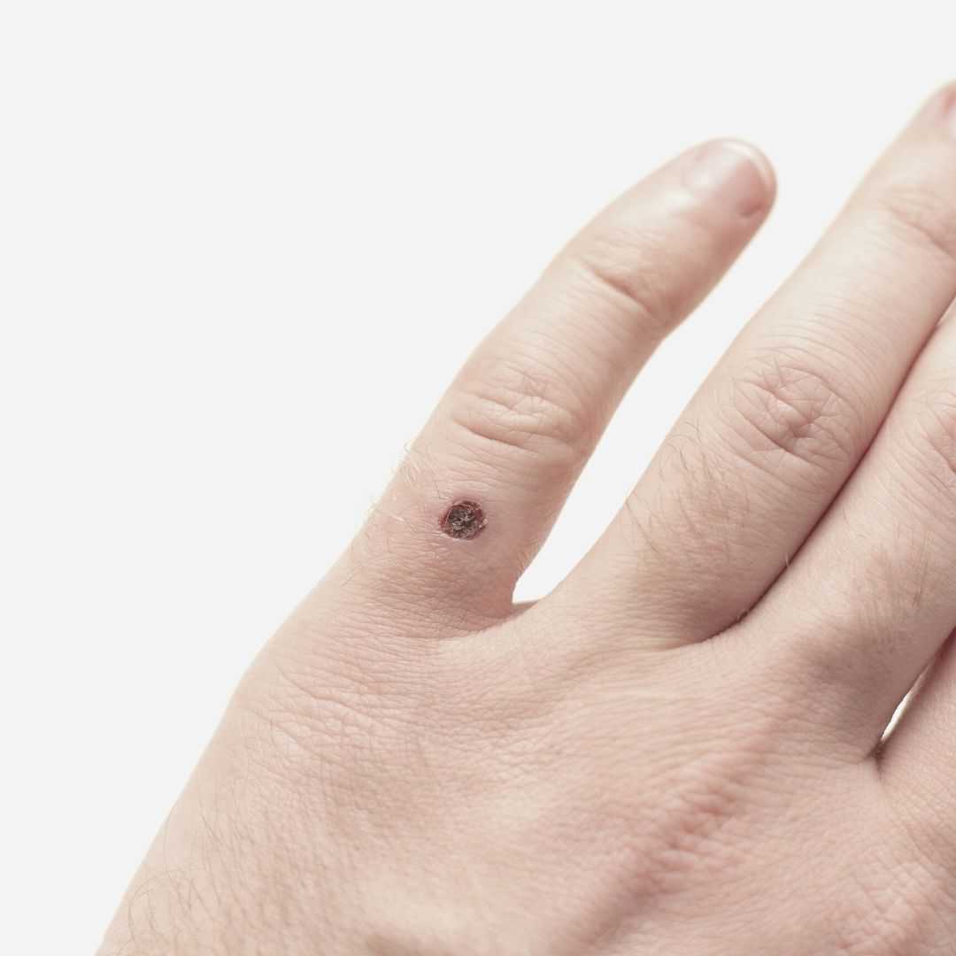 Wart Treatment