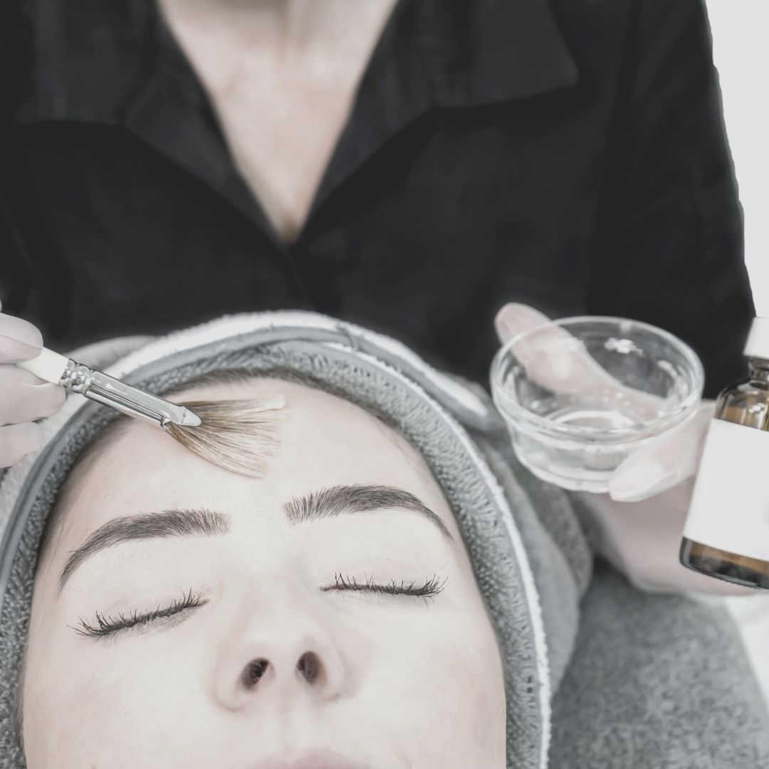 Chemical Peel Treatment